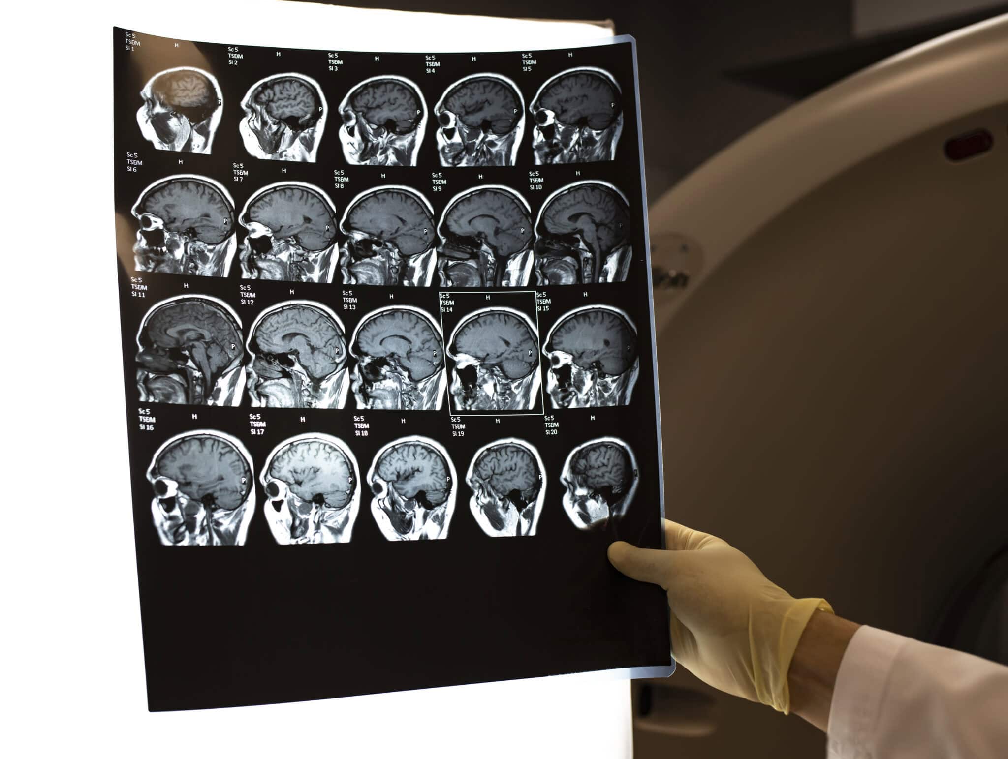 Recognizing the Traumatic Brain Injury Symptoms After an Accident ...