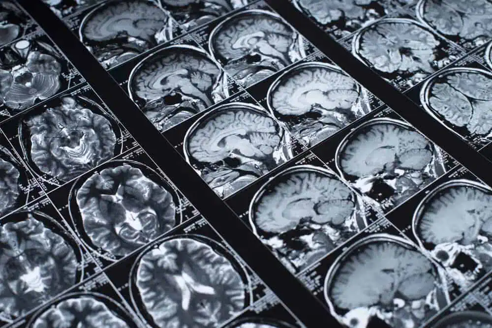 brain scans after traumatic brain injury
